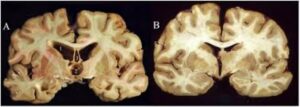 The CTE Mystery: Why Only Football Players?